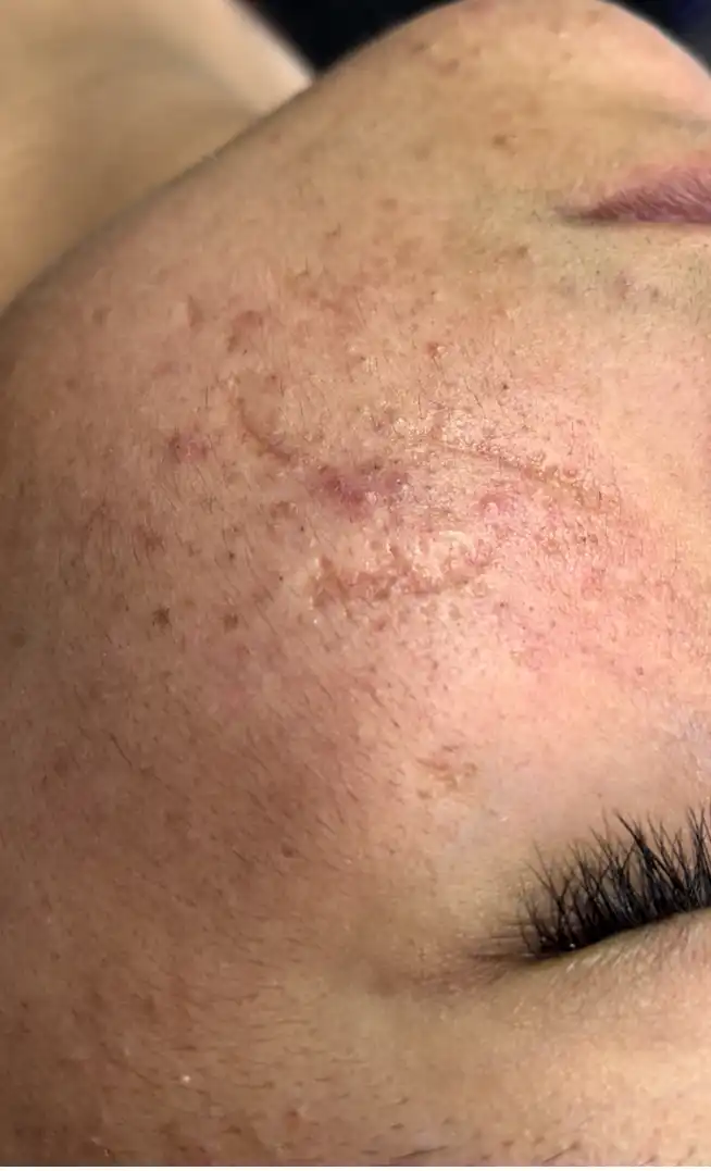 Antes del tratamiento
