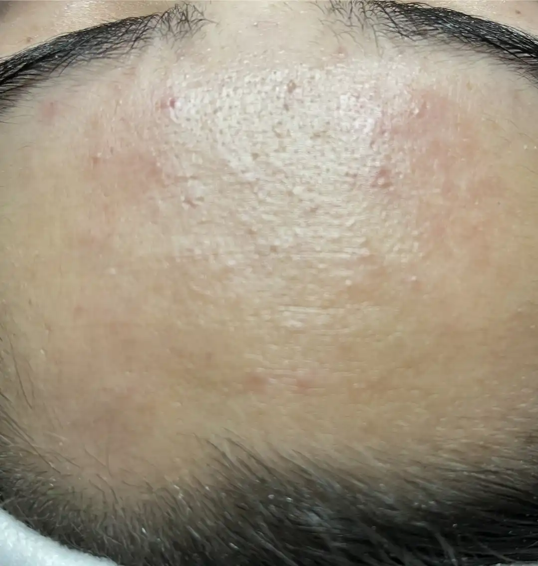Resultado después del tratamiento