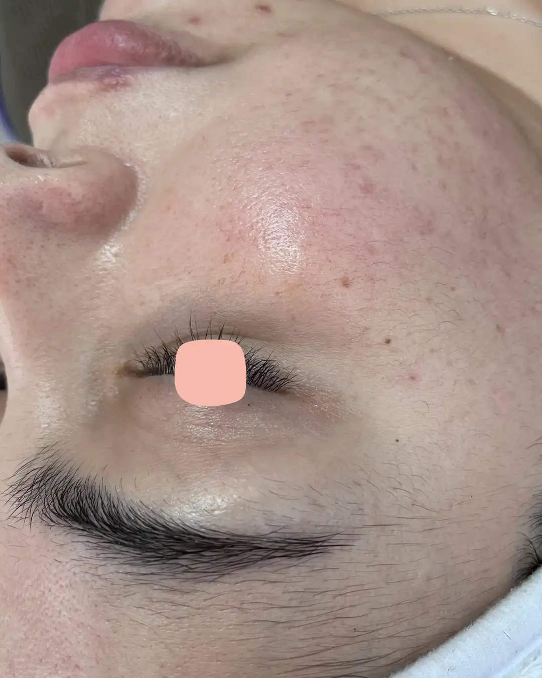 Resultado después del tratamiento